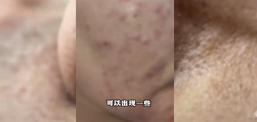 一条用了两年的旧毛巾，竟然让一个小伙的脸烂成了“月球表面”!最近浙江就有这么个事