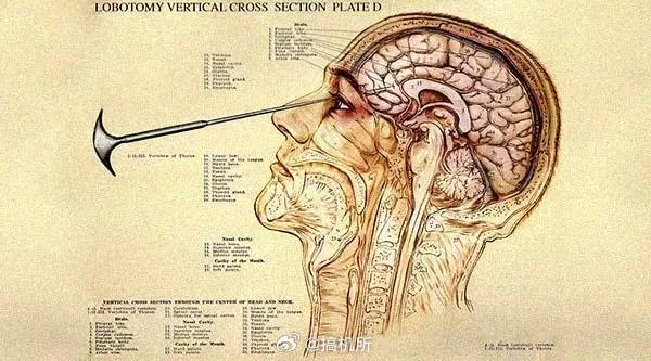 前额叶损伤这让我想到诺贝尔史上最大的污点“前额叶切除术”，直接把精神病人变成活死