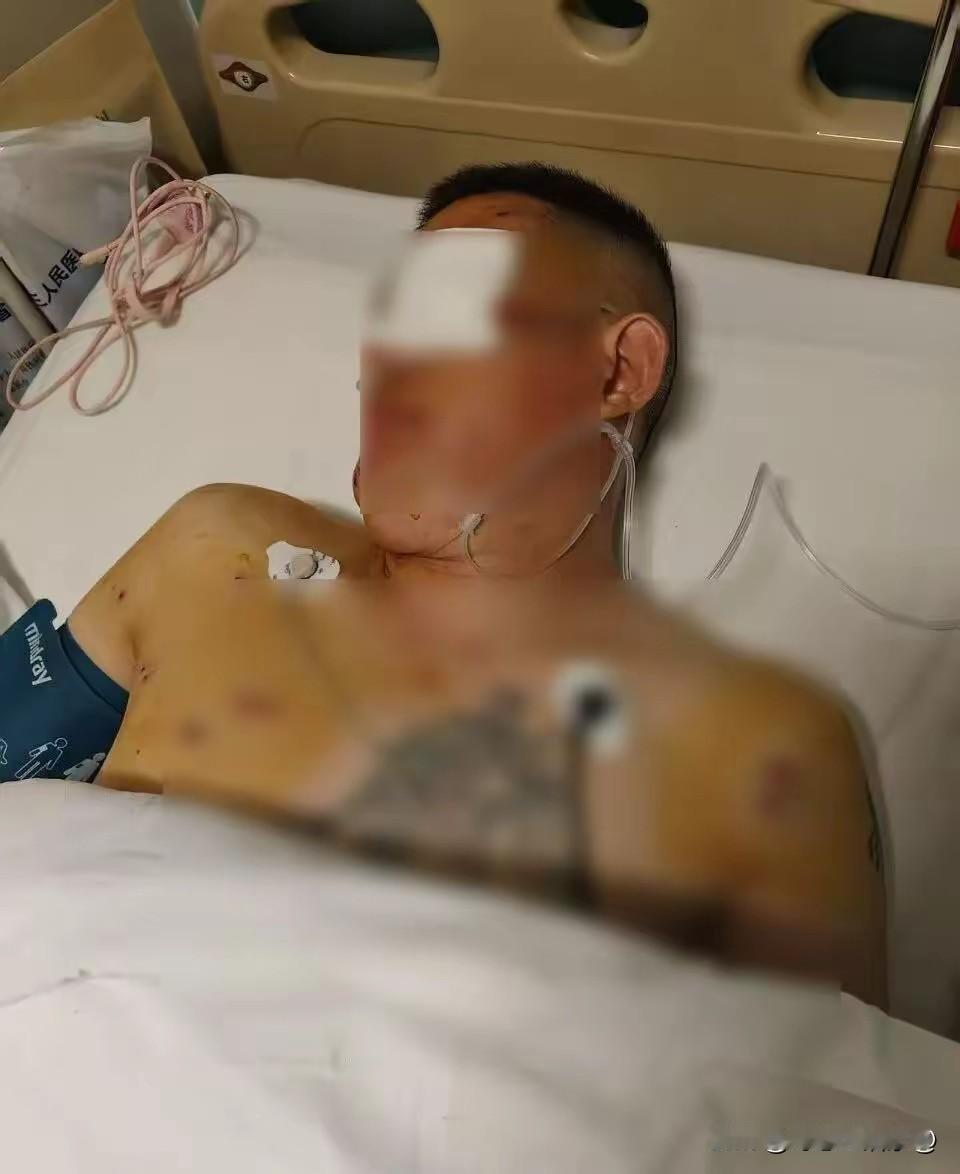  男子银行取170万遭抢劫左眼失明 银行被判无责：去年7月，倪先生在郑州农行取1