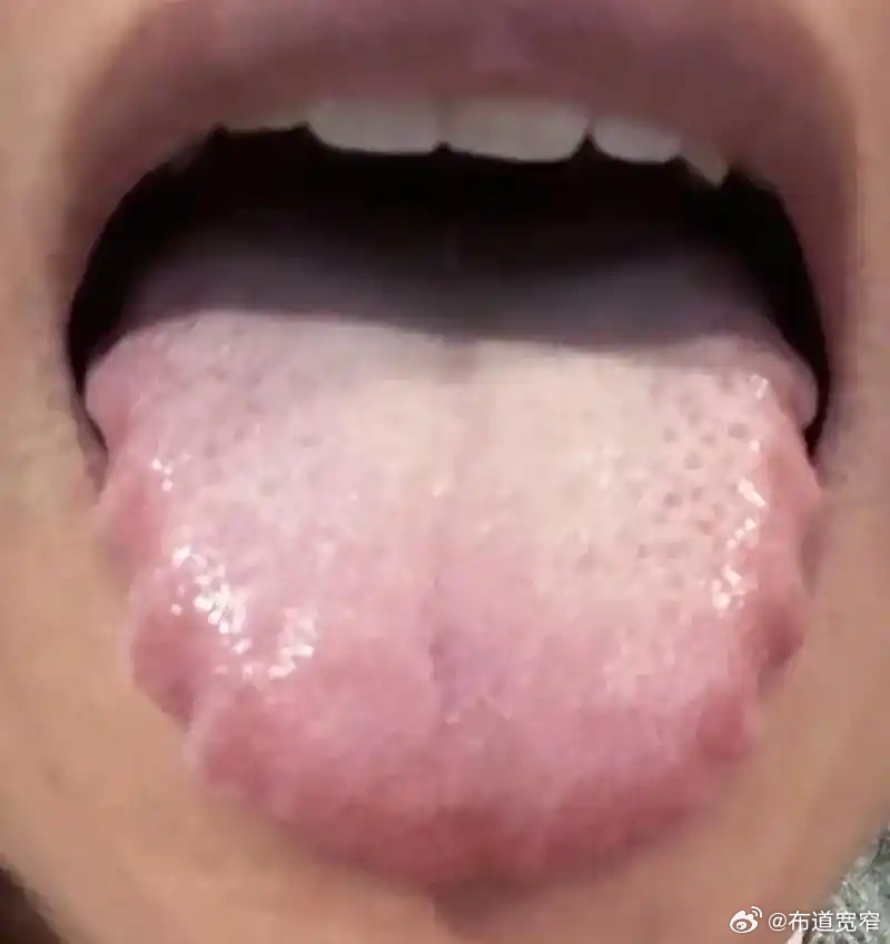 宽窄观察齿痕舌就一定是脾虚吗？ 这个问题点出了当下中医临床上一个很常见的“粗糙辨