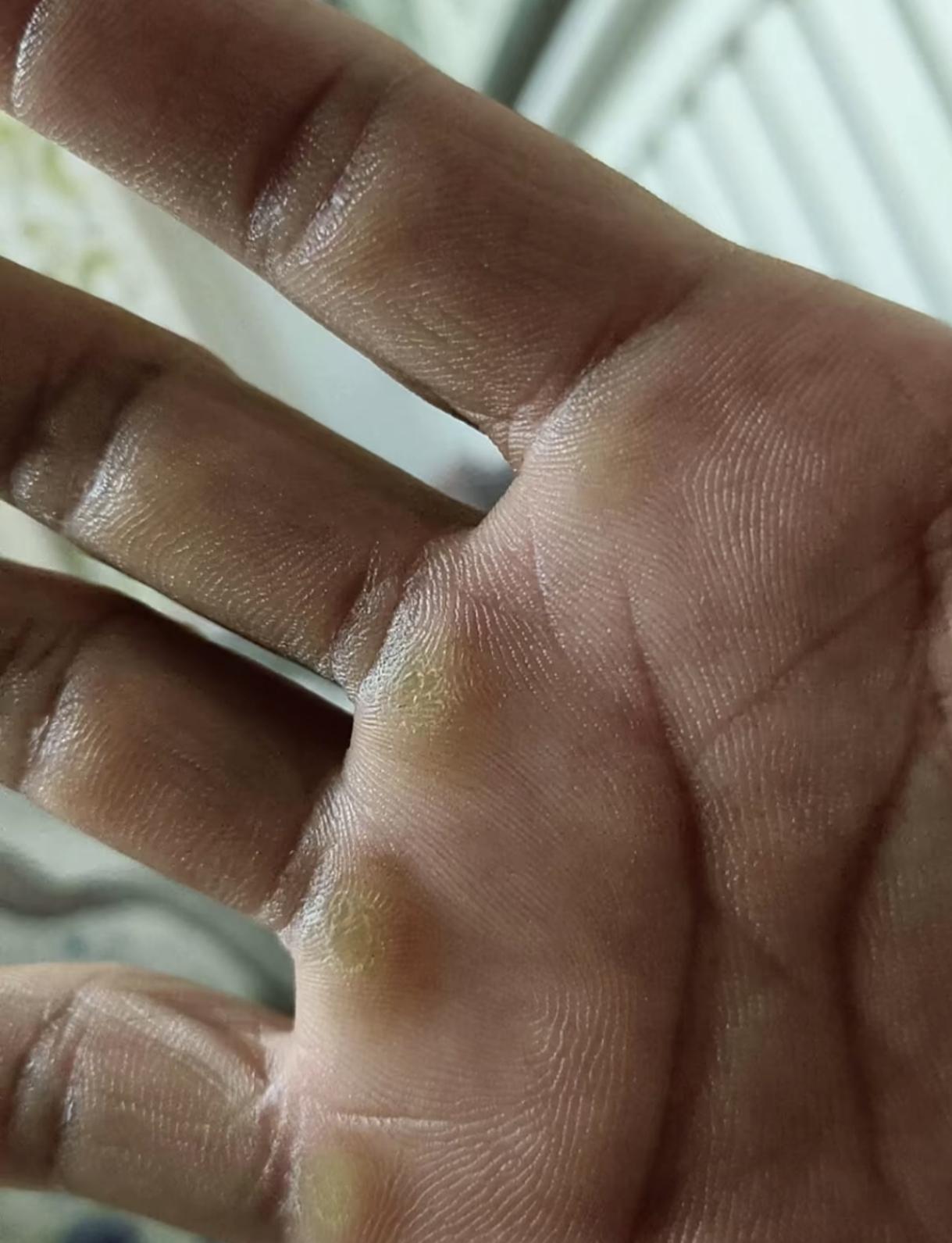 女子感叹自己才26岁 
双手就像七八十岁的老人一样 
这双手，磨出了茧子，也揉出