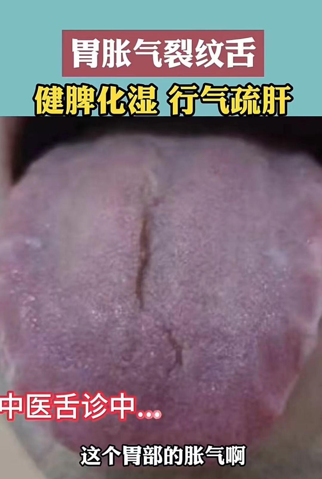 齿痕舌 裂纹舌 中医教你辨证