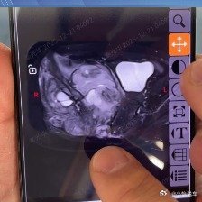 13岁女孩频繁屁股疼确诊骨癌哎呦，还这么小就是骨癌，希望早日康复吧，也提醒大家身