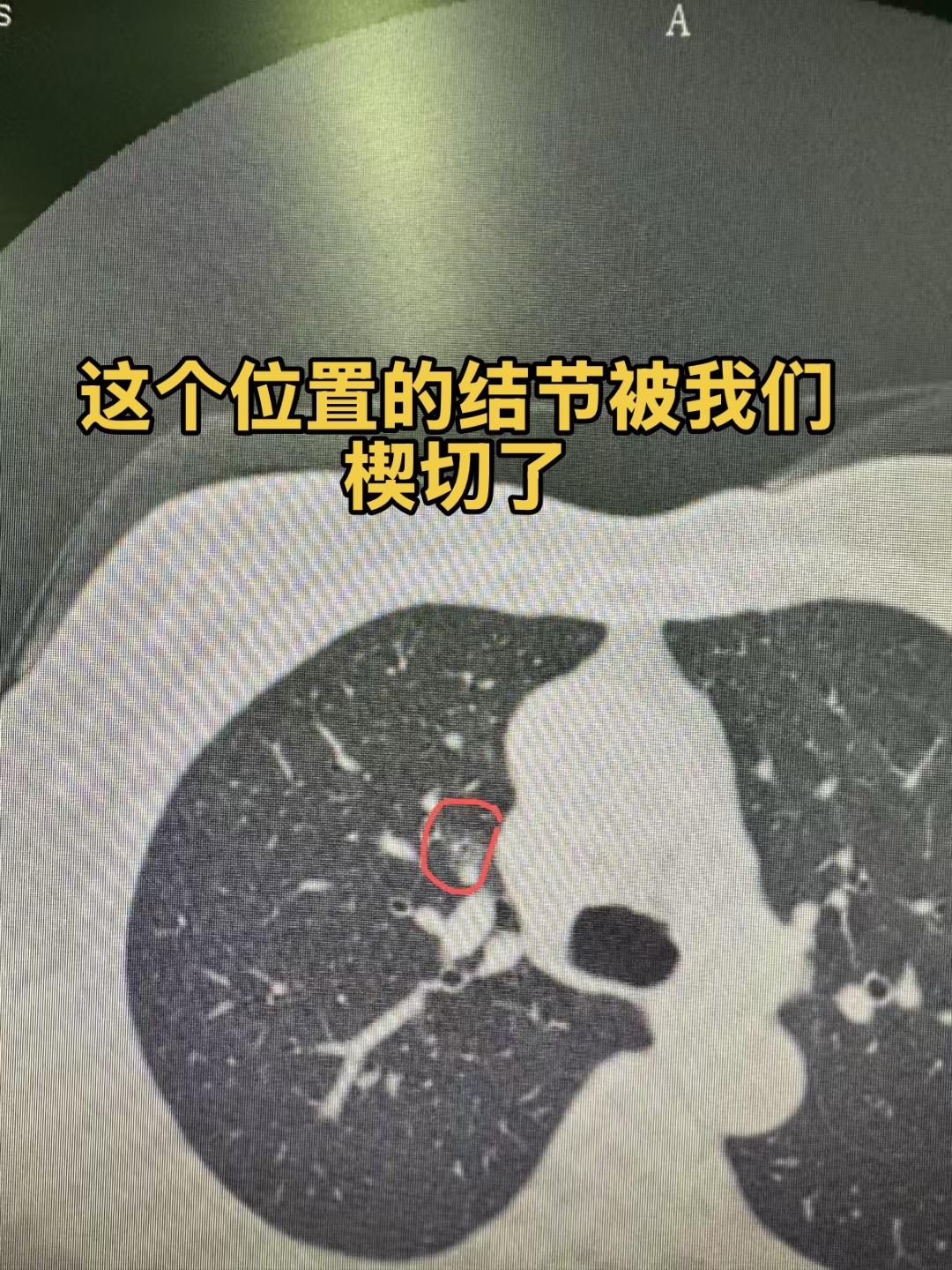 极深部结节的楔切。