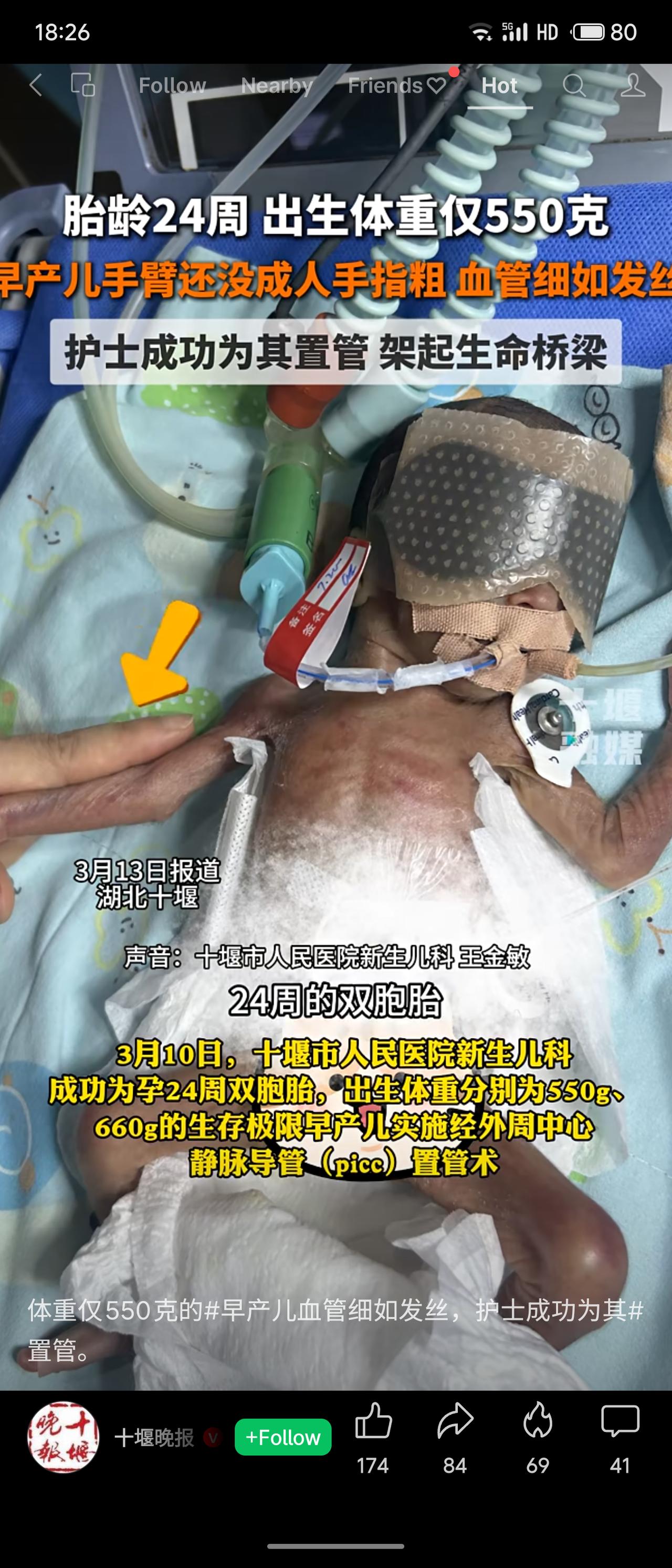 新年爱好打卡湖北十堰市人民医院近日为胎龄24周、体重仅550克和660克的双胞胎