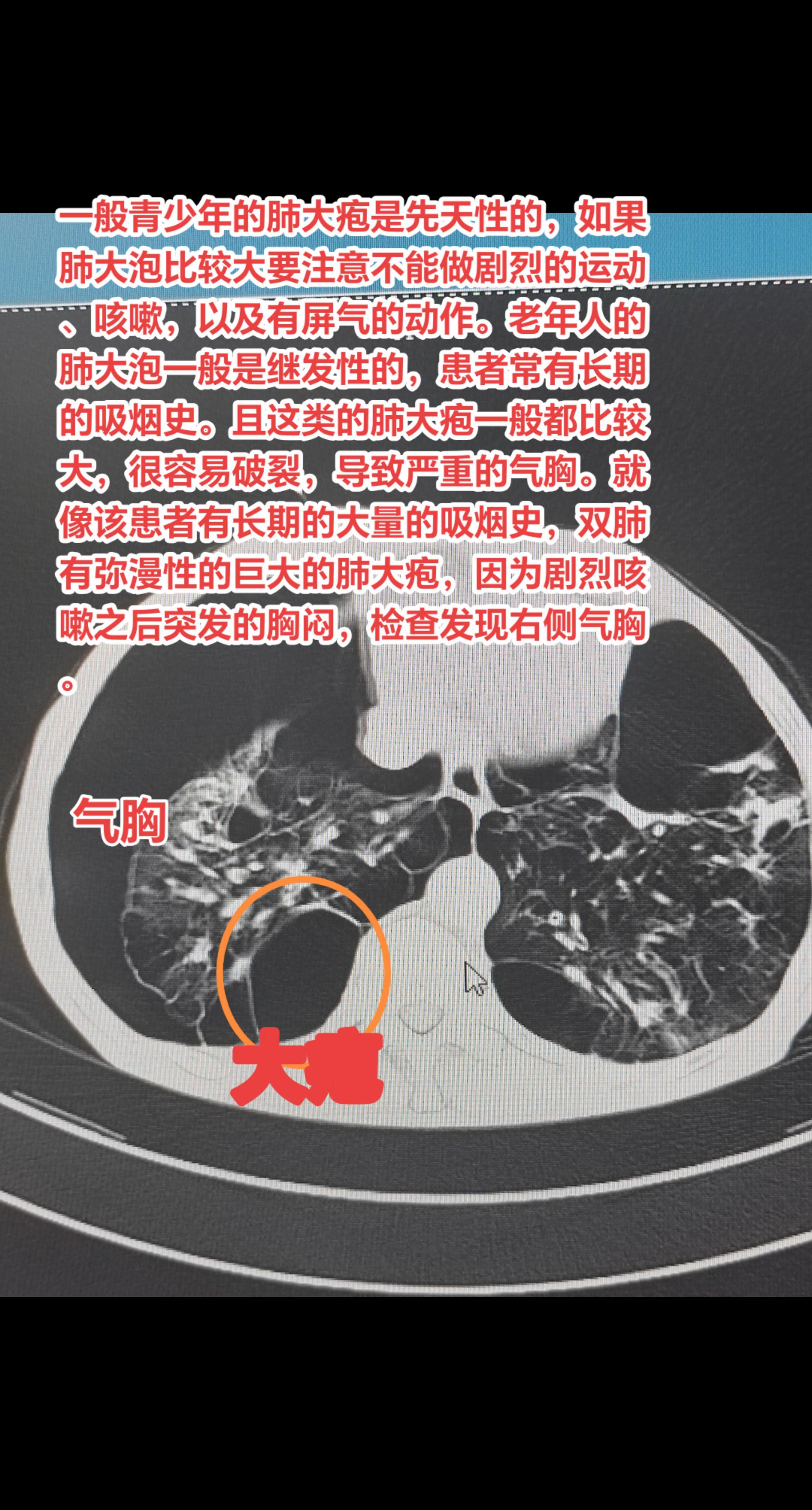 体检发现肺大疱如何处理？一般青少年的肺大疱是先天性的，如果肺大泡比较大...