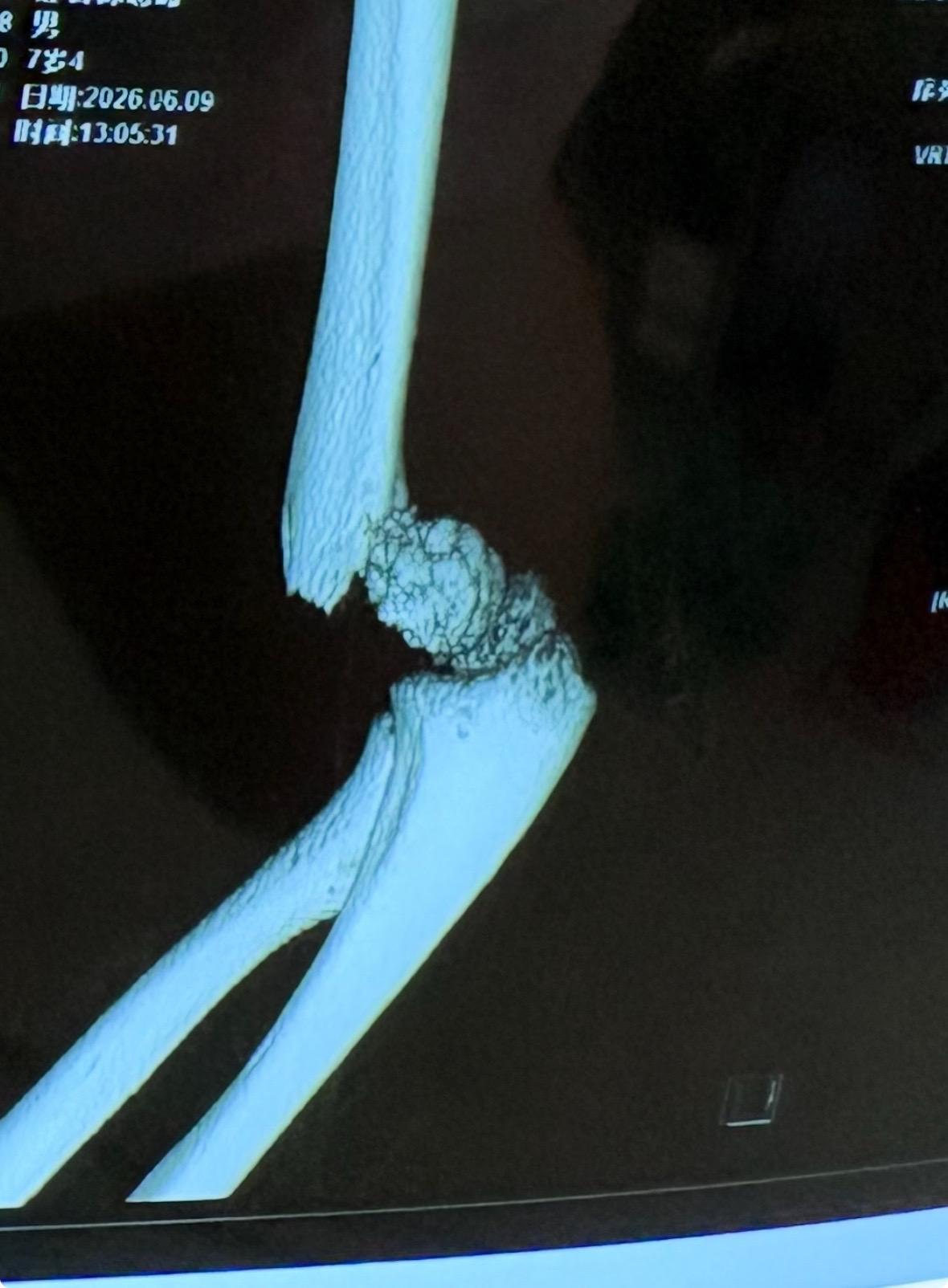 七岁小朋友摔跤肱骨髁上骨折。是儿童最常见的骨折，该类骨折选择闭合复位克...