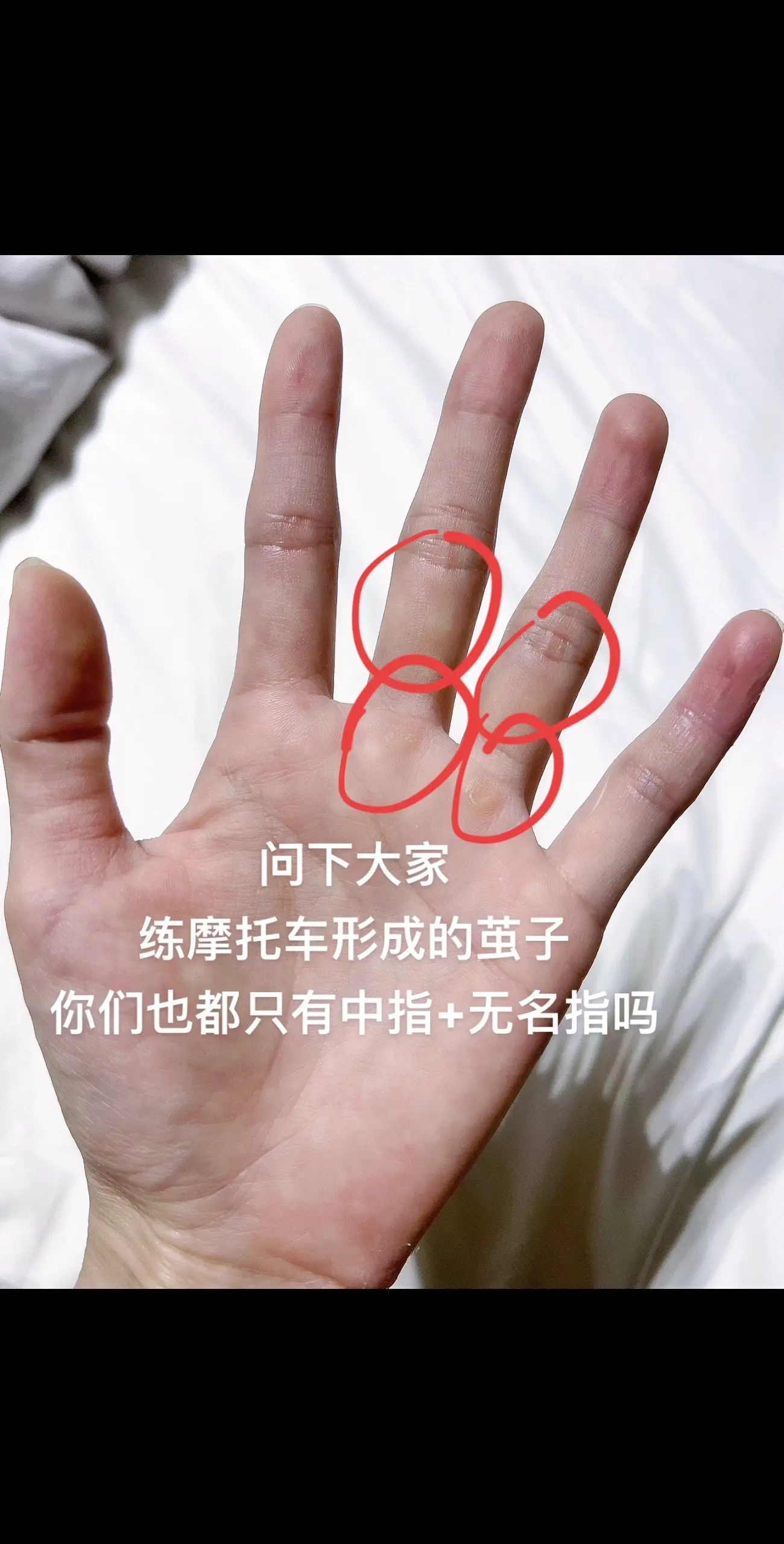 练摩托车，你们的茧子也是只有2颗手指头？