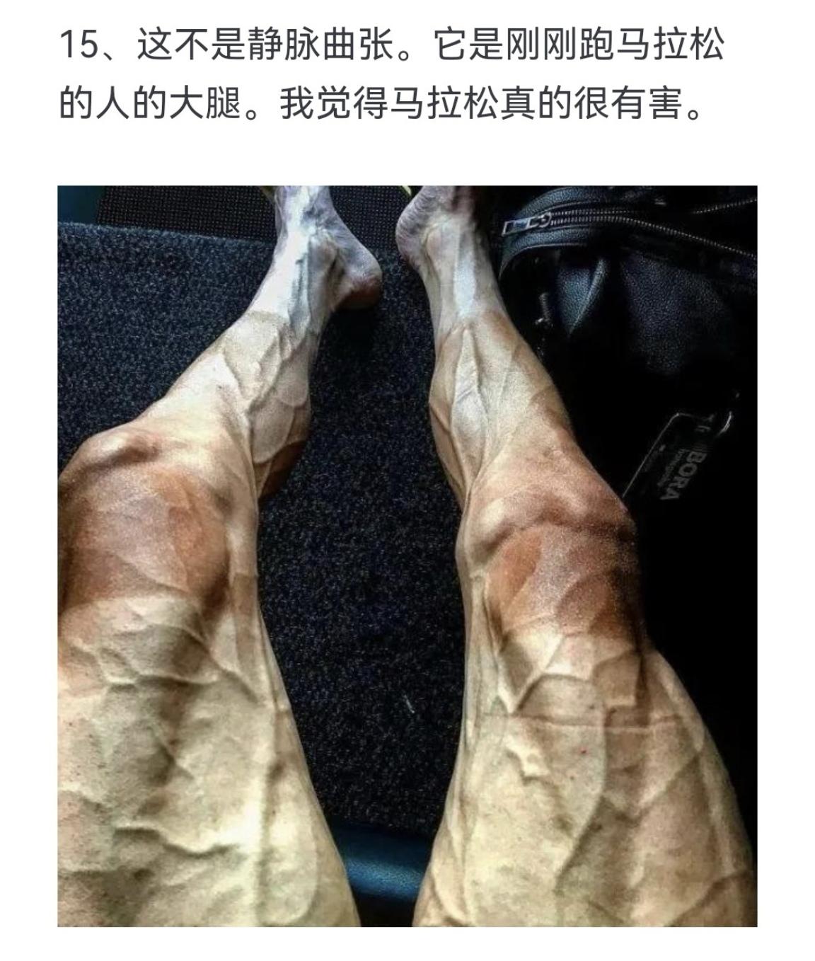 这不是静脉曲张 它是刚刚跑马拉松的人的大腿 我觉得马拉松真的很有害