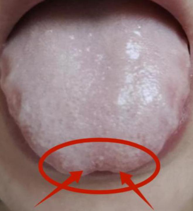 舌尖发白补心、舌中发白补脾，舌根发白补肾

1、舌尖发白补心
辩证：心属阳脏，主