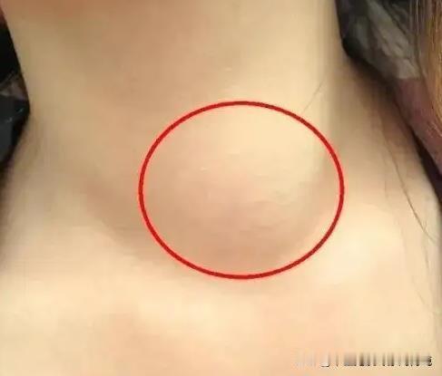 甲状腺结节，要针对病机，软坚散结、理气活血！
大家好，我是中医刘博纯。
最近有许