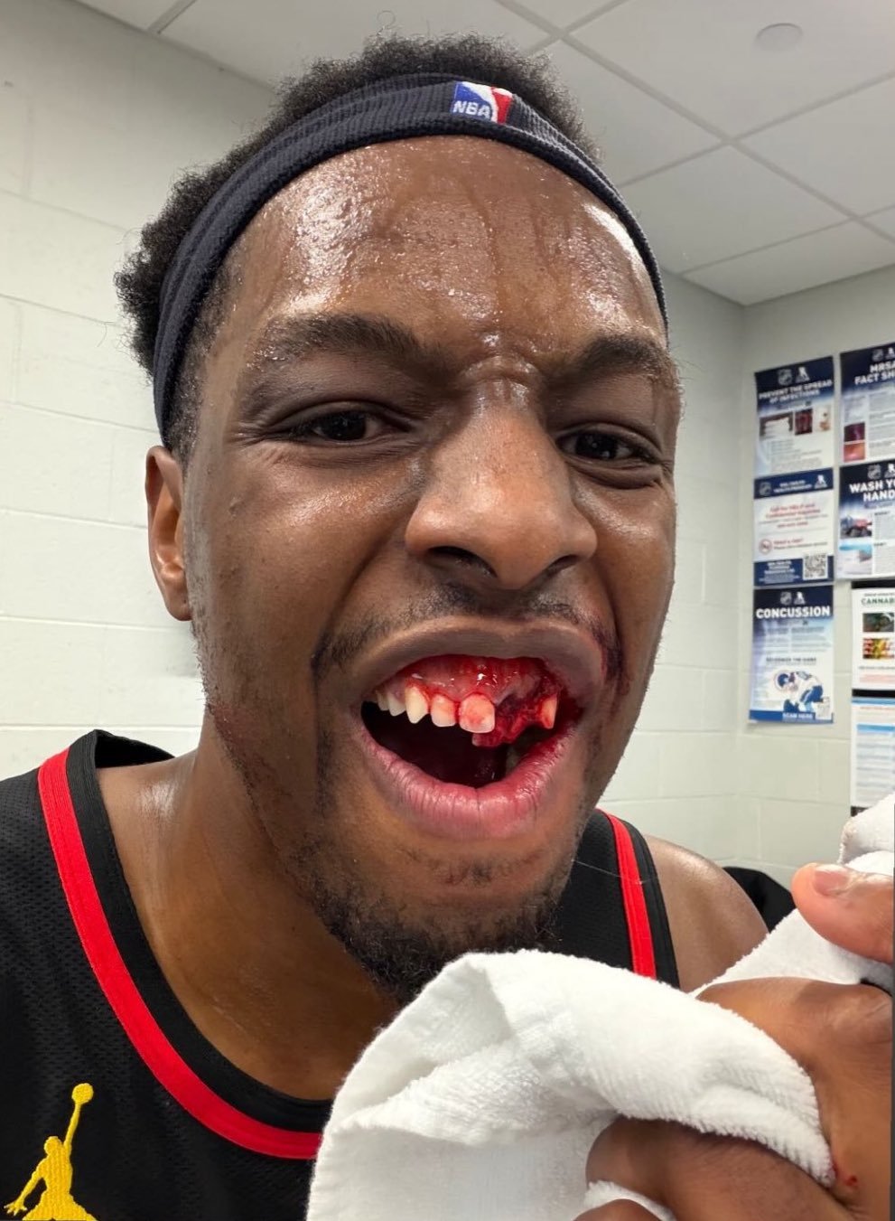 奥孔古被布朗肘的牙齿都掉了