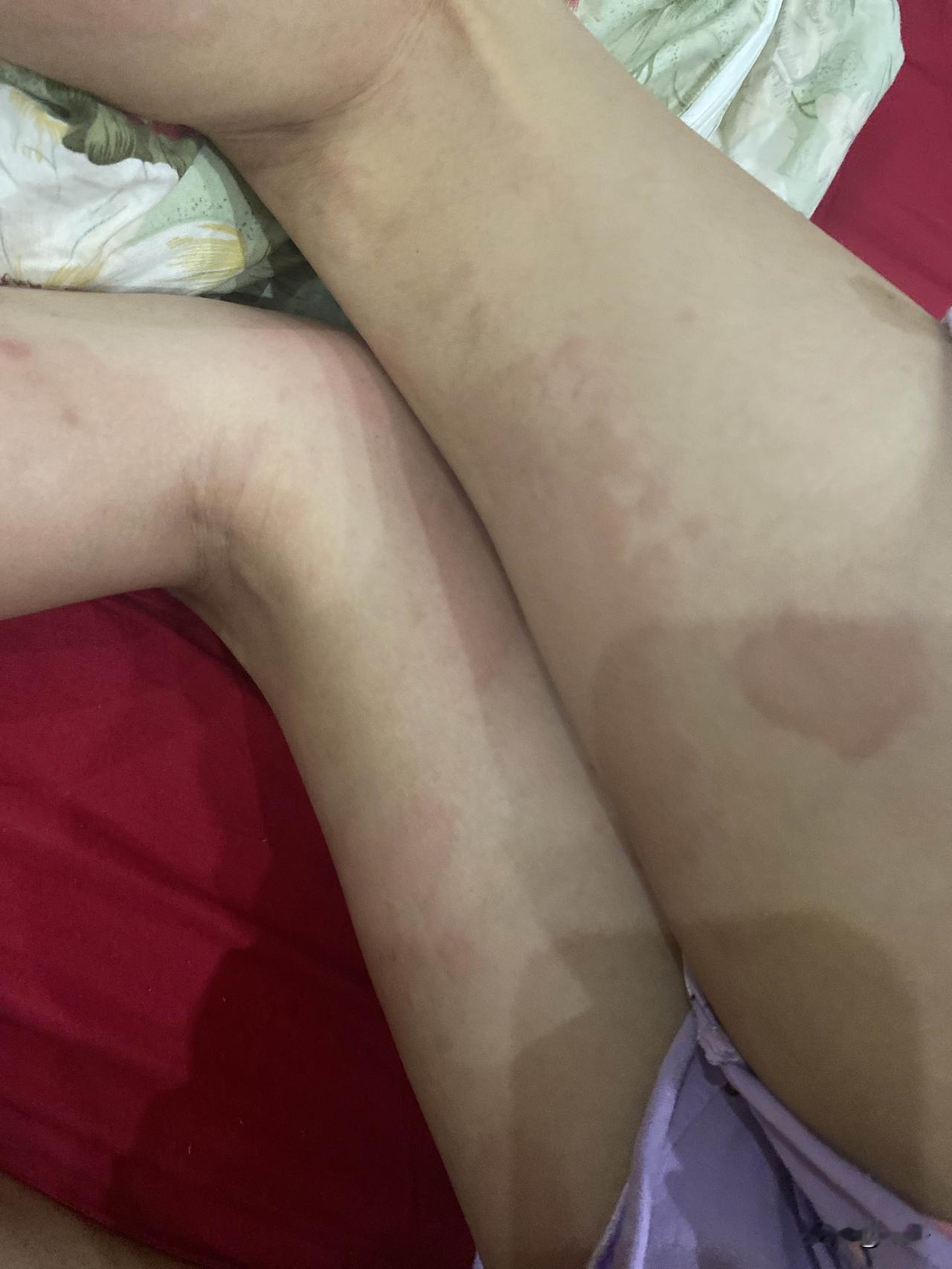 下午我女儿睡了一觉起来腿上长满了荨麻疹，真是担心死我了，刚做完手术一个星期身上就