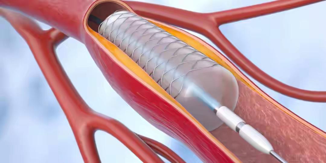 ❤️ 心梗后坚决不放支架会怎样？医生实话实说：2种结局，没有中间路
——这不是“
