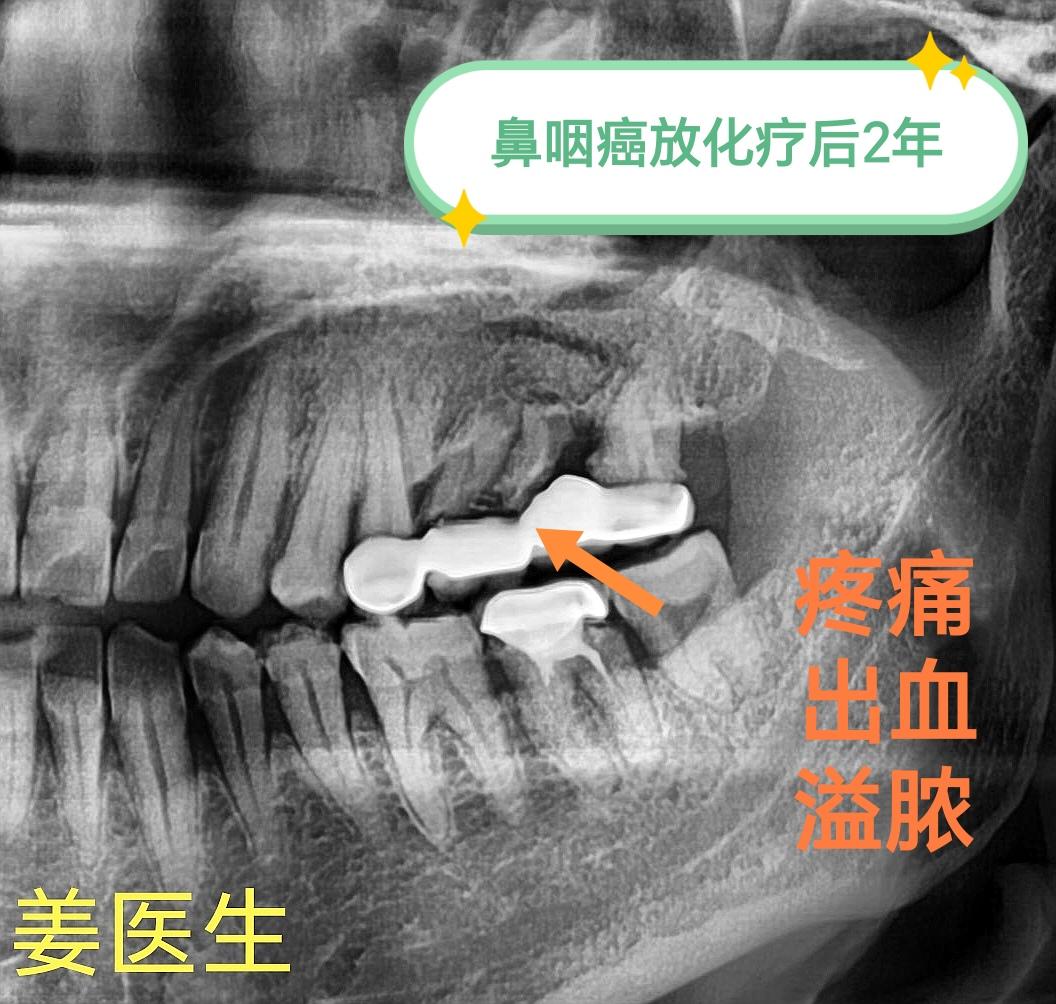 鼻咽癌放化疗后2年，拔牙。2周后恢复良好！头颈肿瘤