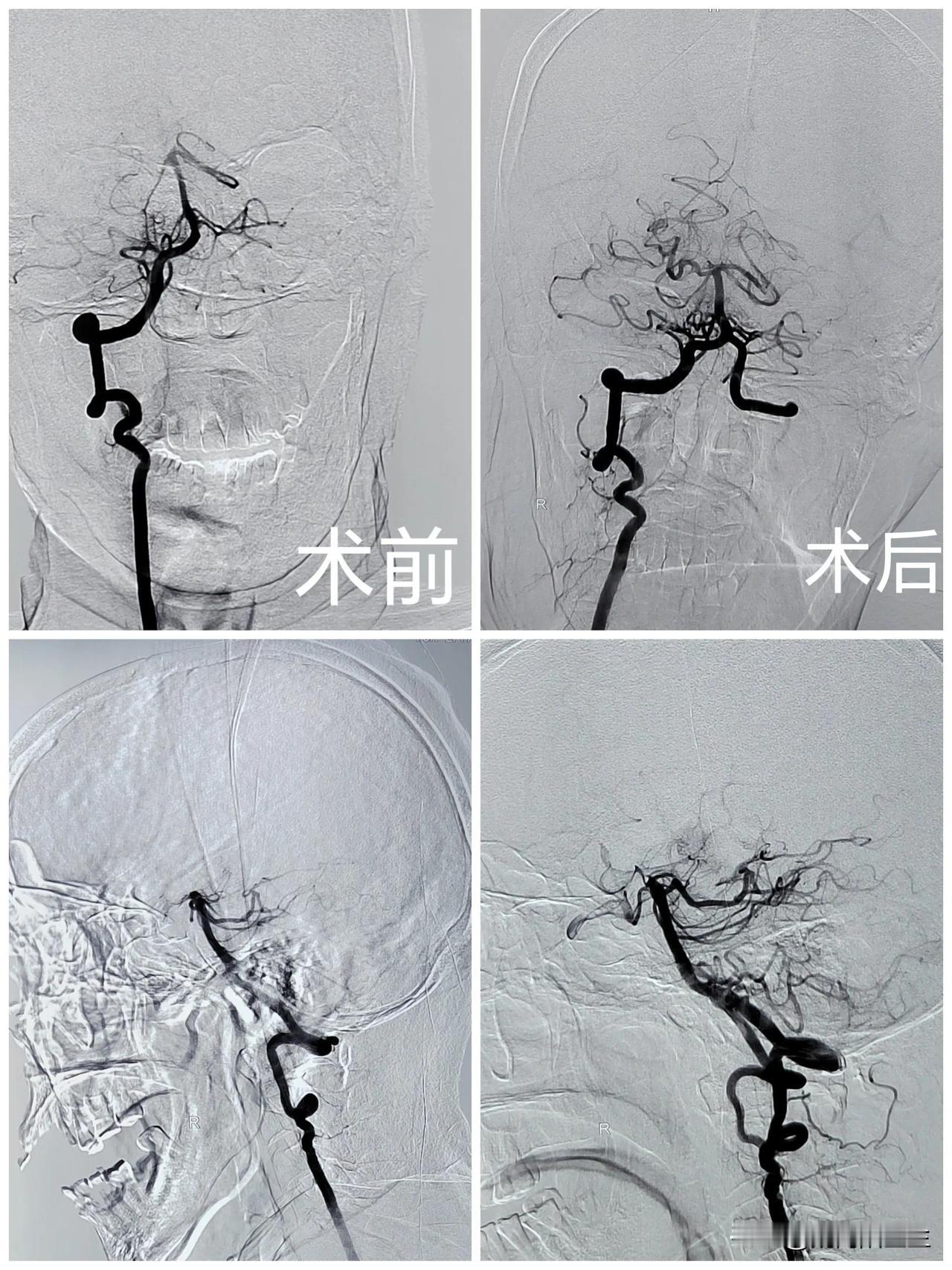 76岁老人，晚上睡觉，两小时之后被家属发现不能叫醒，呼吸节奏较以前异常，伴有明显