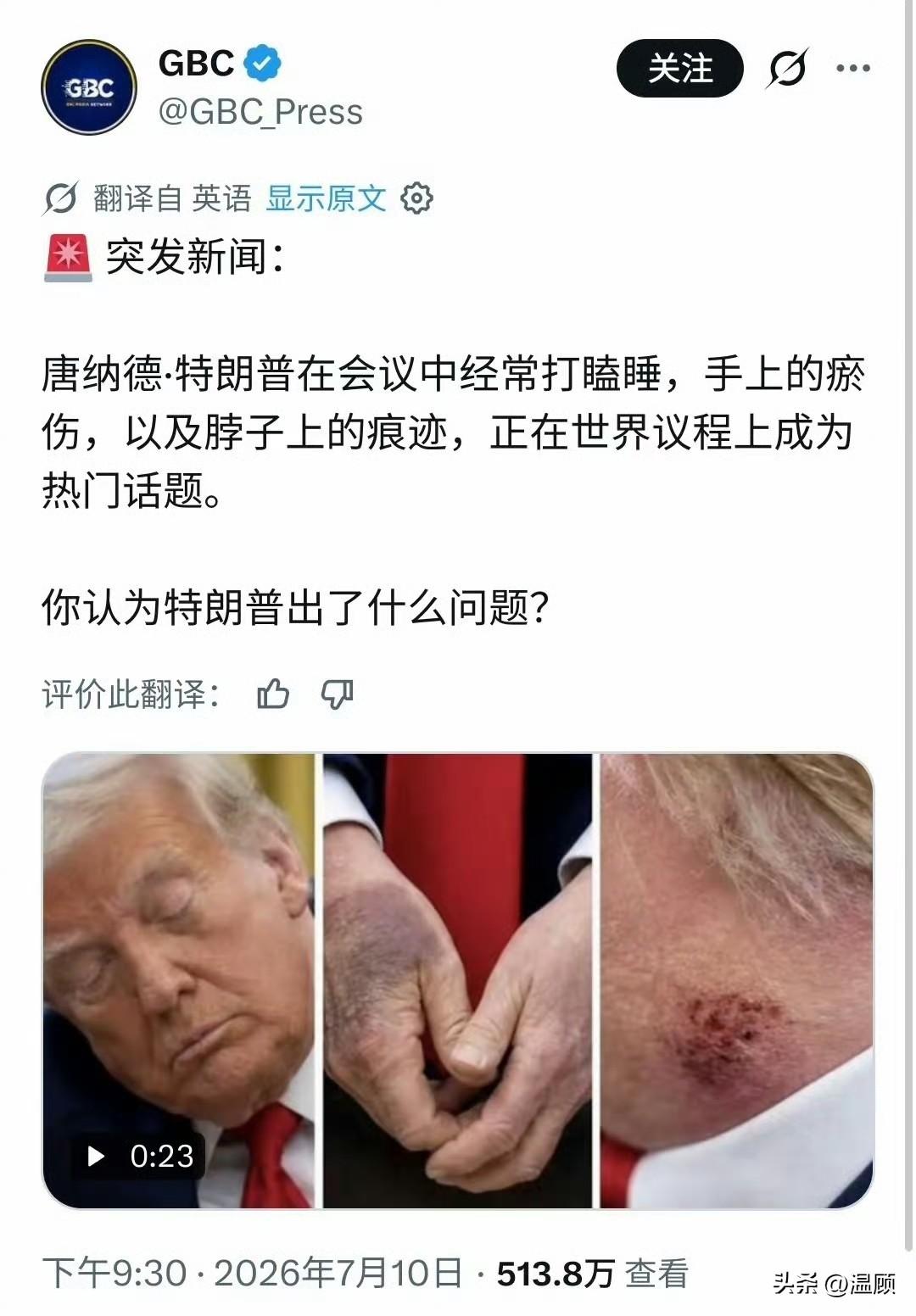 除了开会打瞌睡、手背大面积瘀伤，特朗普颈部再添明显伤痕……作为即将年满80岁的高