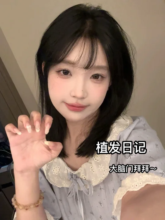 植发plog|终于和大脑门说再见了