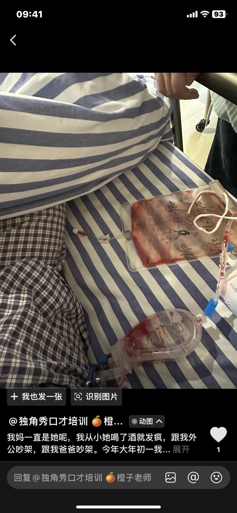 大年初一肠穿孔住院，亲妈喝醉酒来病房发疯，我伤口崩裂渗血，硬缝针没打麻药

真的