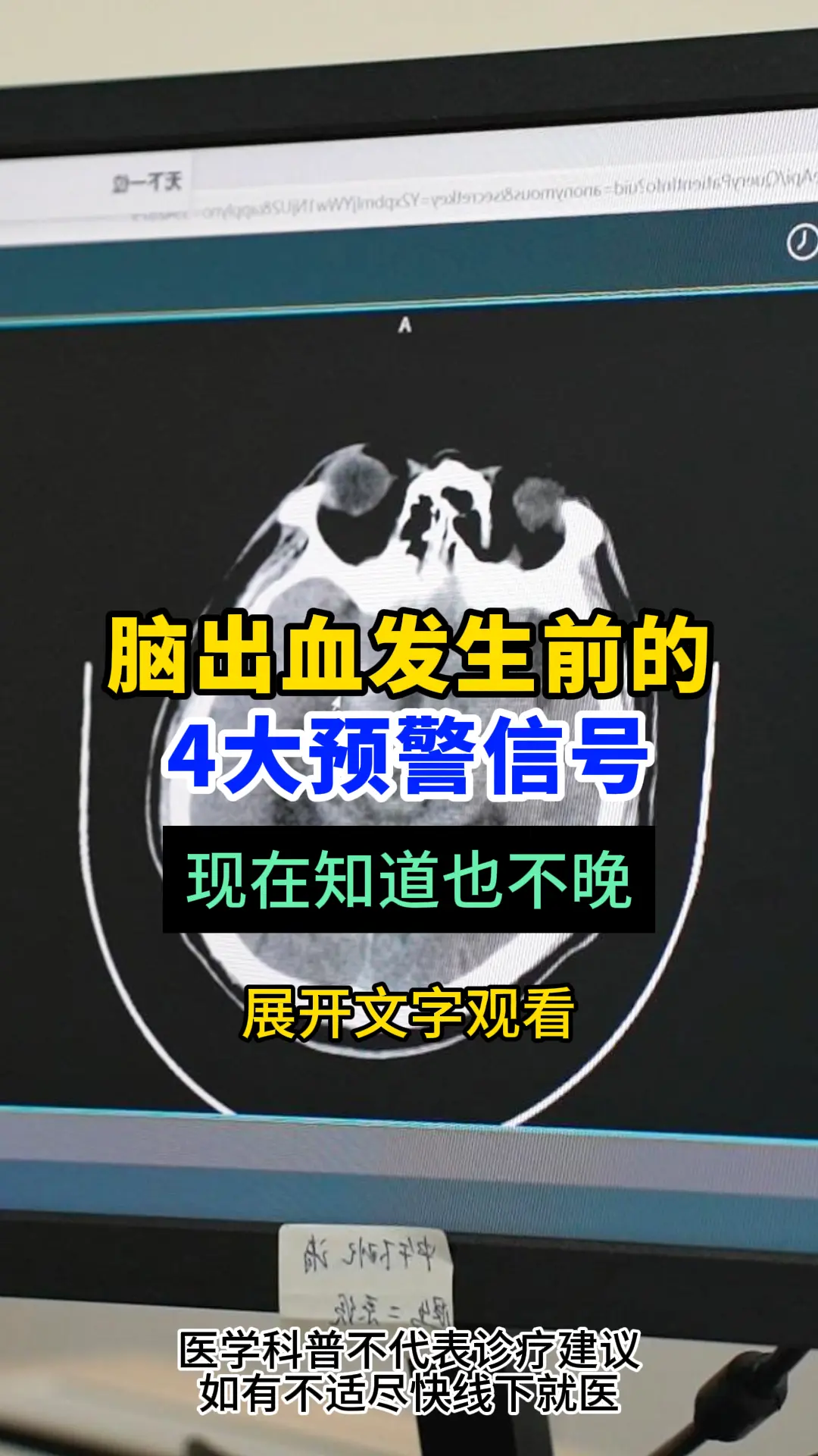 脑出血发生前的4大信号，现在知道也不晚。脑出血的发生致死致残率很高，如...