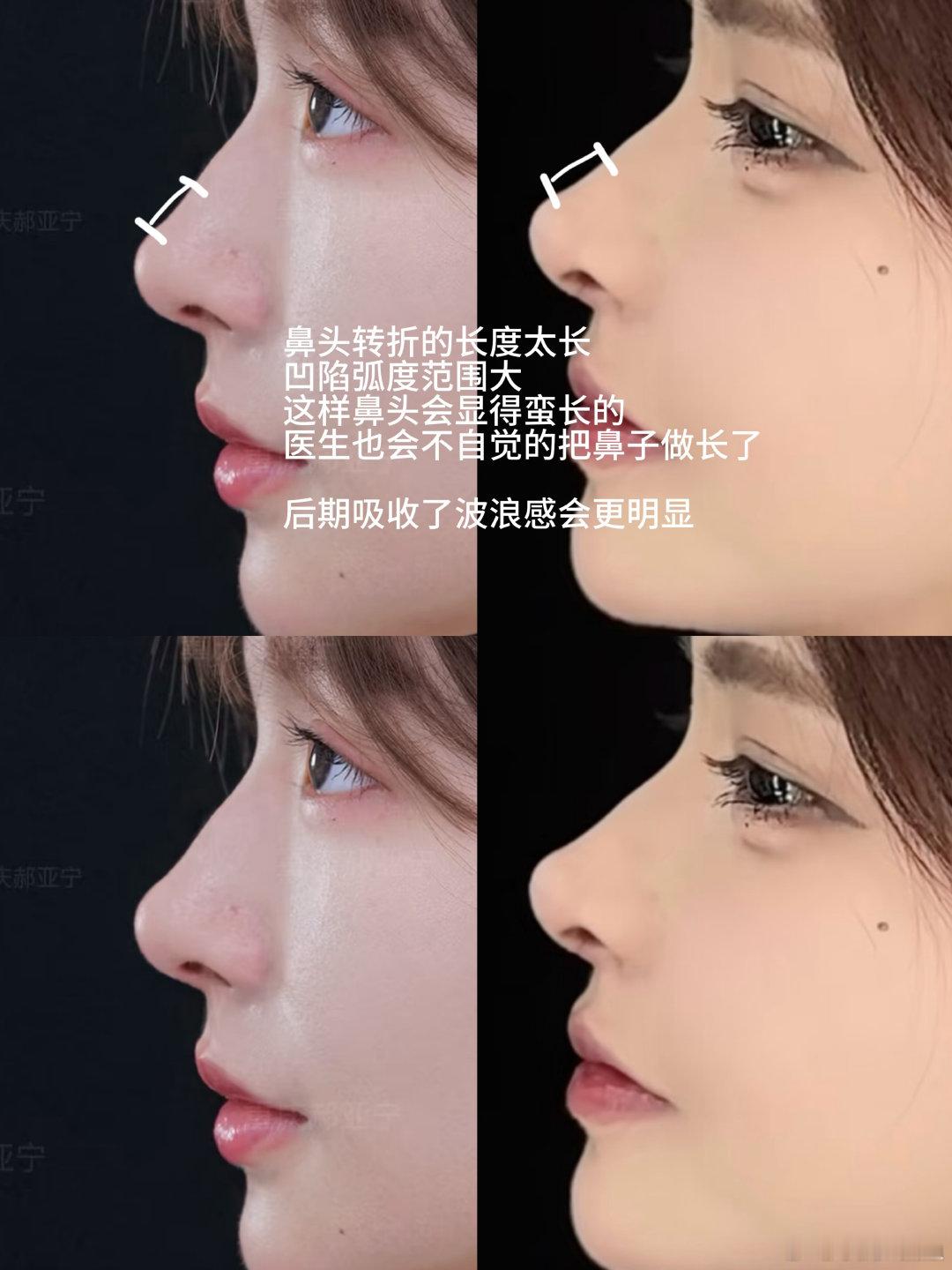 我最喜欢的鼻子是图1图2 xlj做的这个案例鼻头转折点很神 鼻头很精致符合我要的
