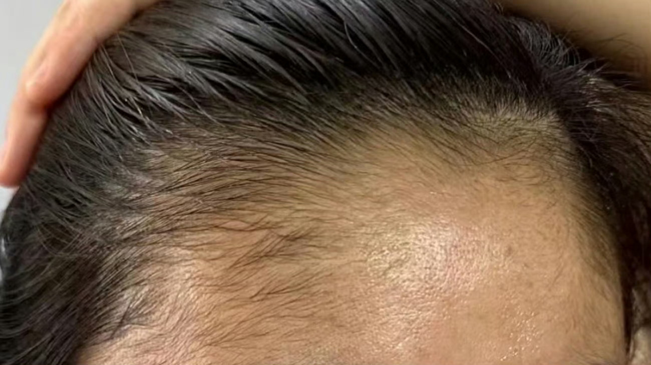 额头发际线长得杂乱、伴有细碎绒毛的人，往往性情急躁如火，起伏不定，内心难以安宁，