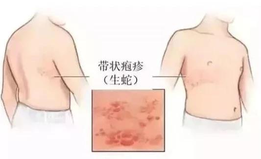 “蛇缠腰”让人痛不欲生？两招助你快速康复！

你是否曾被一种被称为“蛇缠腰”的疾