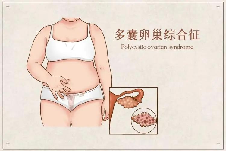 #健康真探社#【“多囊”可以影响女性一生？】有不少人认为月经经常好几个月不来潮（