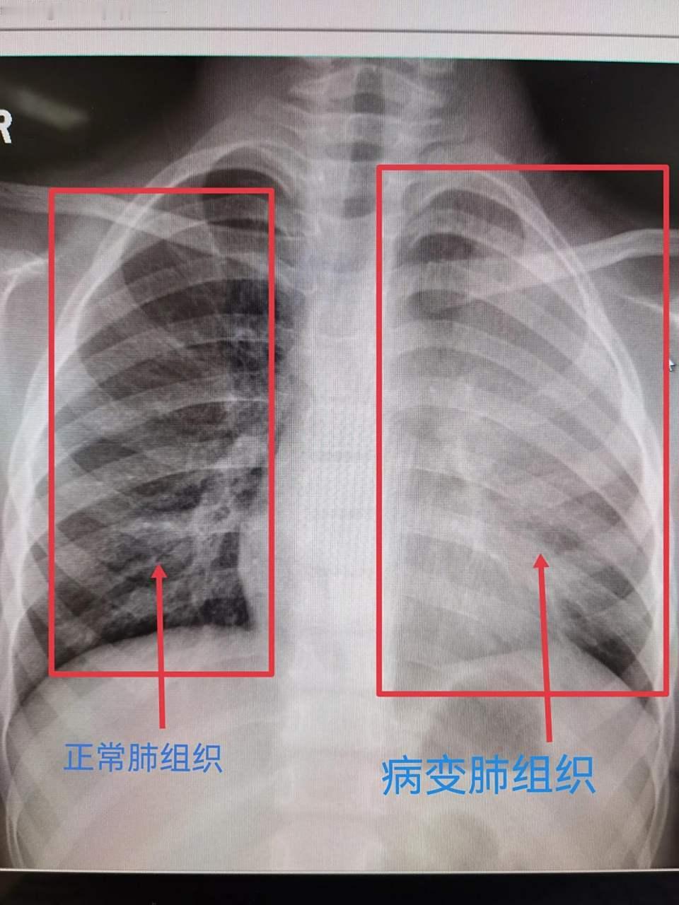 男子吹空调3天变白肺