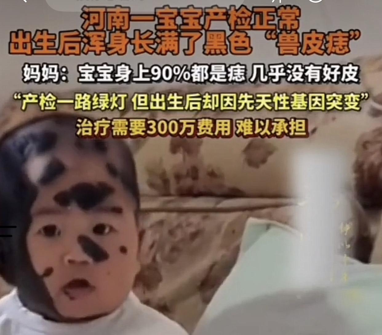 11月11日，一则“宝宝产检正常，出生后满身兽皮痣”的消息登上热搜。一位河南母亲