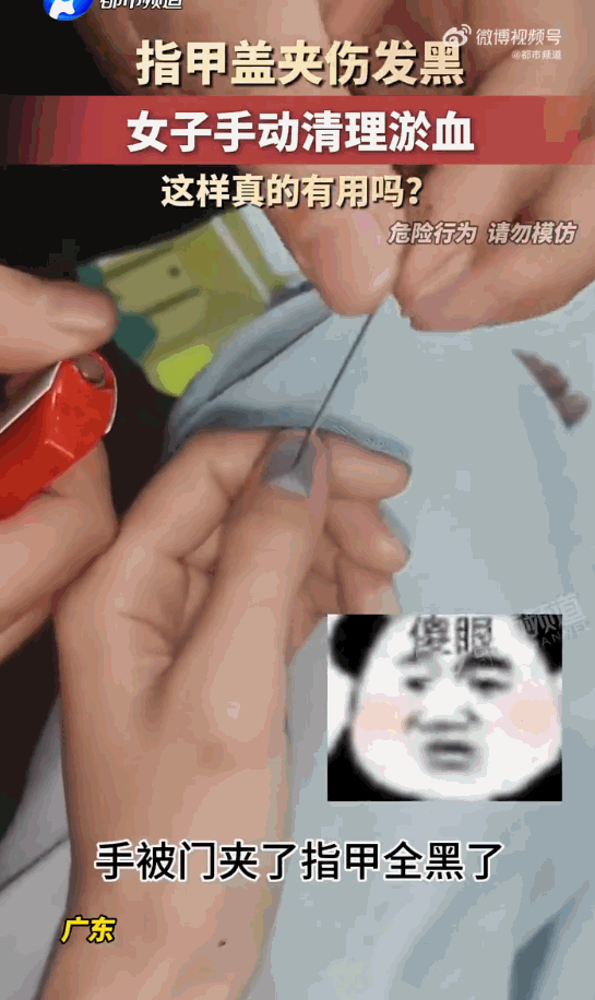 这样真的有用吗？广东，一位女子的右手大拇指不小心被门给硬生生夹伤了。没一会儿工夫
