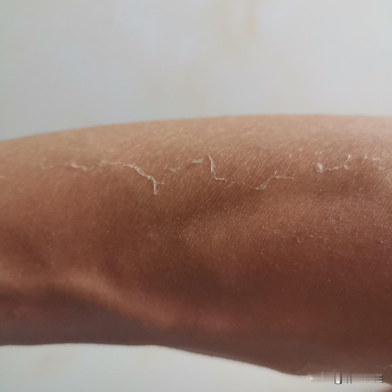 秋季是光子嫩肤黄金季节？勿轻信
看看这秋季光子嫩肤的效果（图）
像蛇蜕皮……
