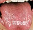 补肾看舌根，发红多阴虚，发白多阳虚，裂纹多精亏
1. 舌根位置颜色发红，舌苔很少
