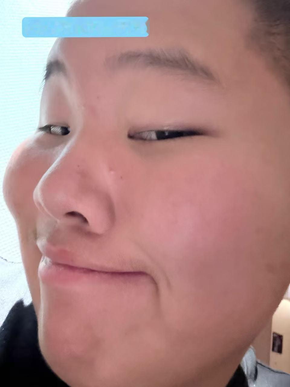 战痘这事儿，很多人第一步就走偏了。要么手痒去挤，要么跟风刷酸，结果痘痘没消，屏障