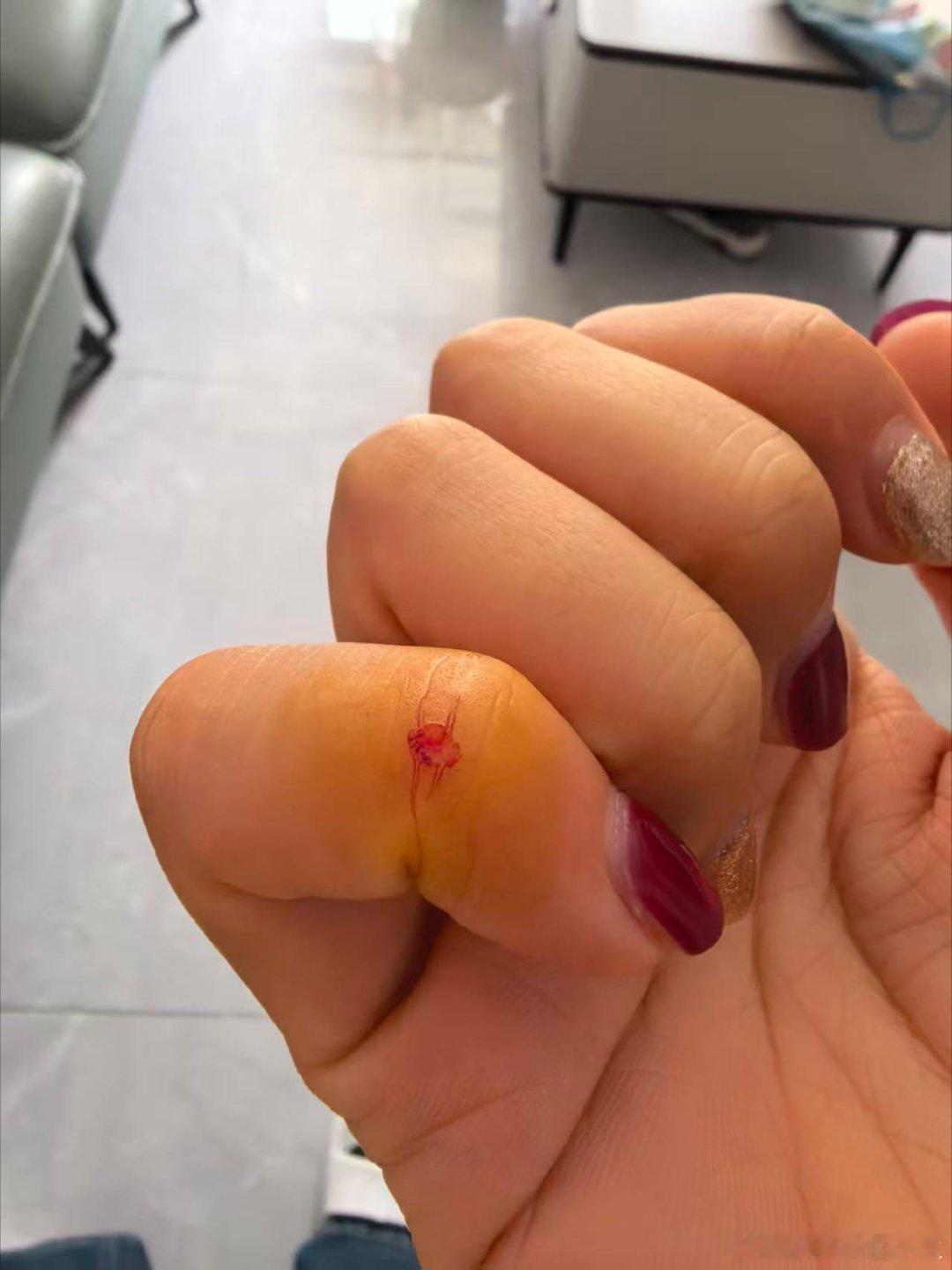 哎，被邻居家鹦鹉🦜把手咬破了，这种需要打针吗