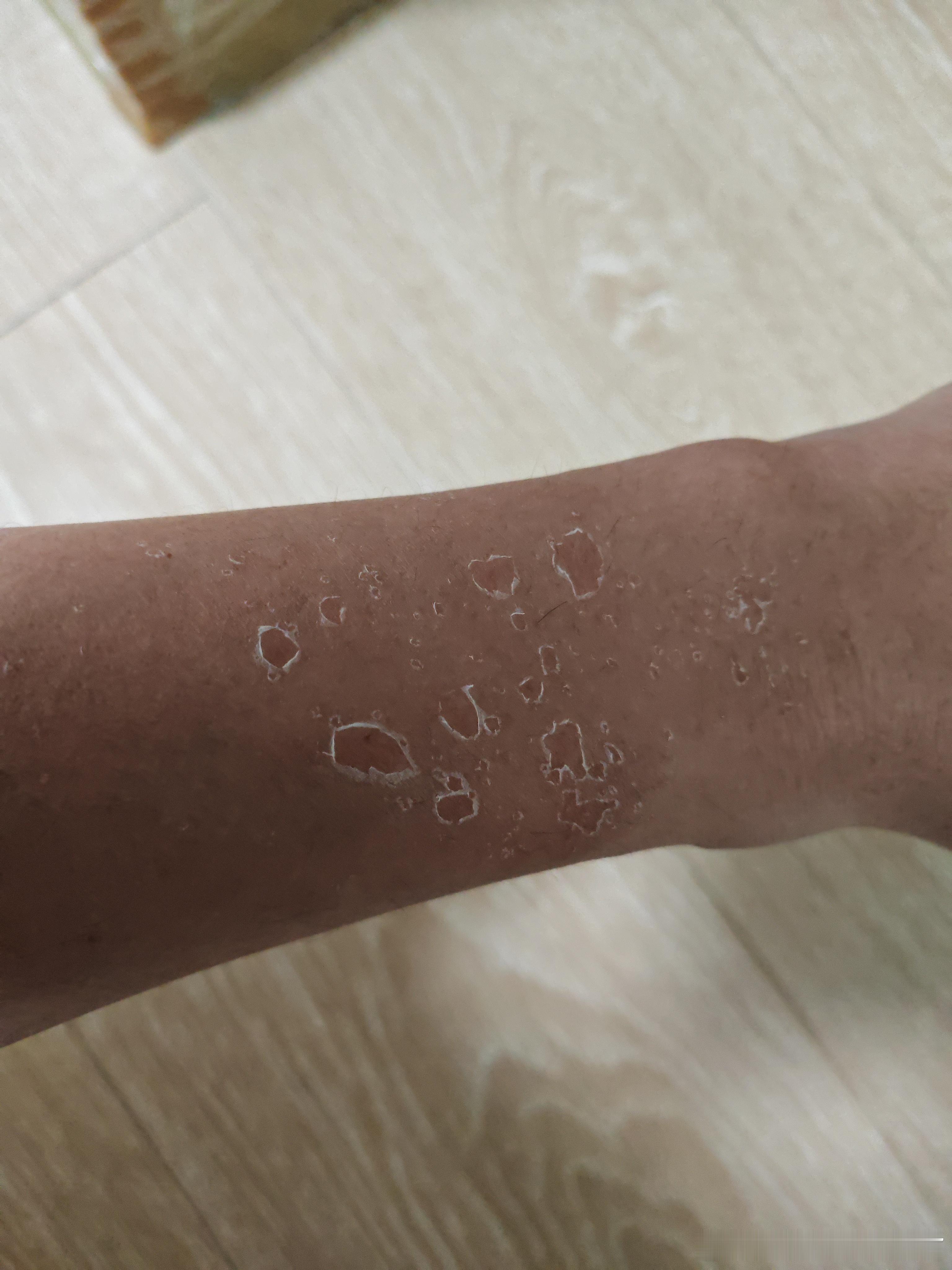我震惊了！今天晒两个小时太阳，手居然被晒脱皮了！ ​​​