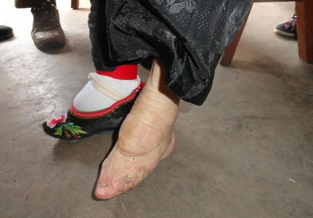 缠足的演变本质是男权审美从“精致化”到“病态化”的递进。宋代裹足仅需足型变窄，明