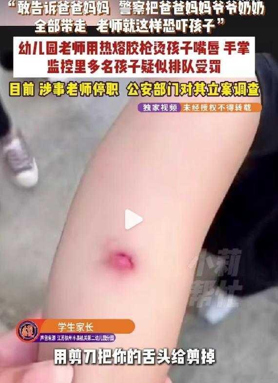 多名幼儿园小朋友被老师用热熔胶烫伤 这个老师不是坏，就是蠢，而且是坏得很，蠢到家