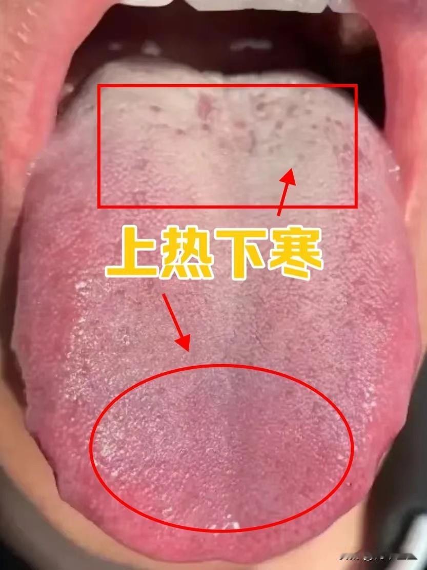 上热下寒 血热成瘀 还有肝火和脾虚
这位患者是因为爱上火来看病的，我问诊的时候，