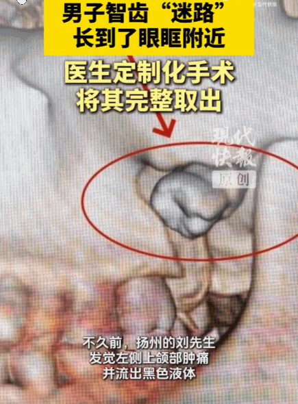 万万没想到！扬州，一42岁男子有一颗叛逆的智齿，多年来没有正常萌出，反而一路“潜