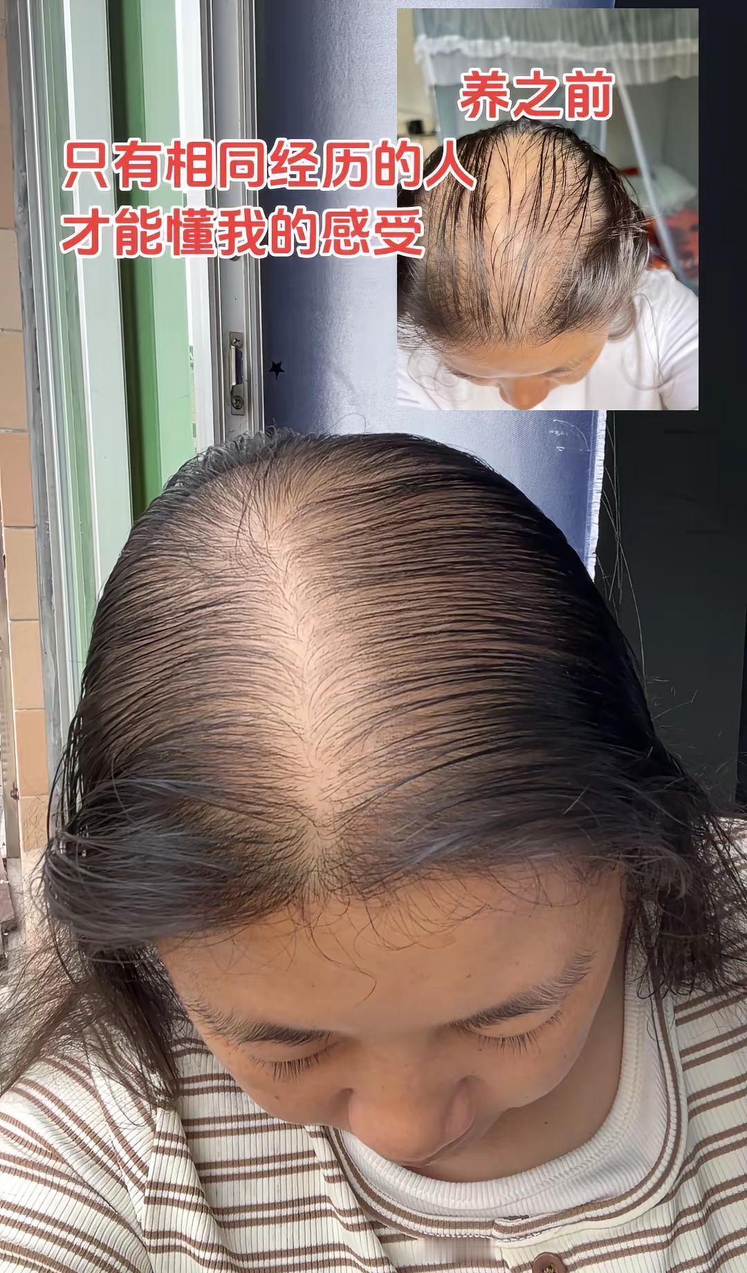 26到35岁的女生，发缝越来越宽，不是变美了，是撑不住了。
加班到凌晨，娃半夜哭