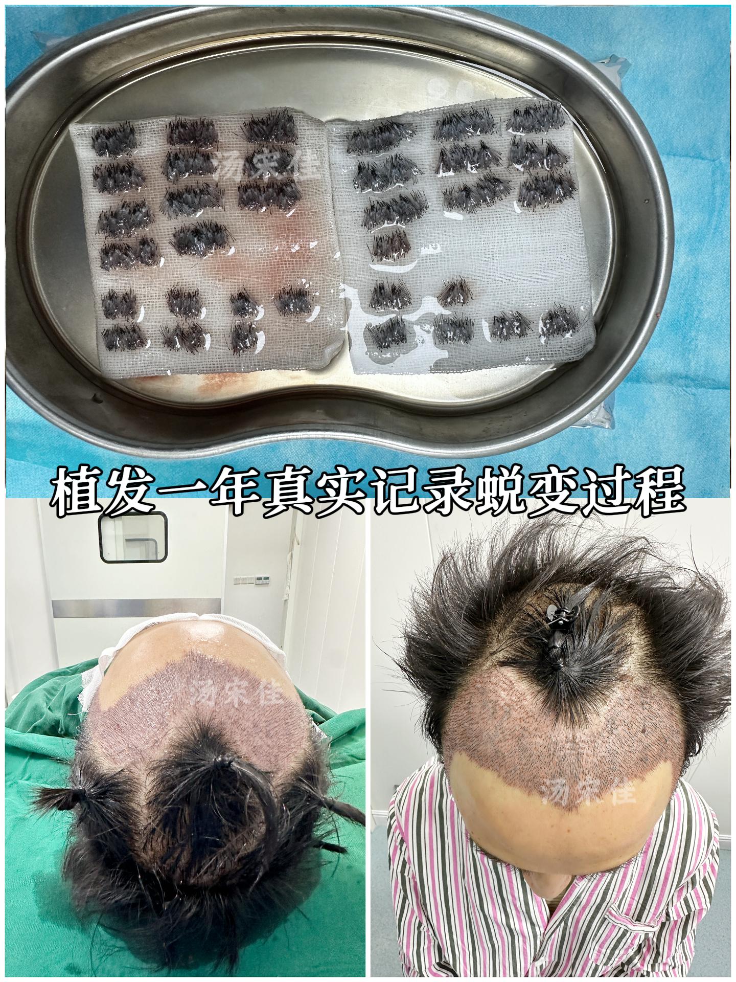 发友植发一年的反馈！真实记录术后蜕变。