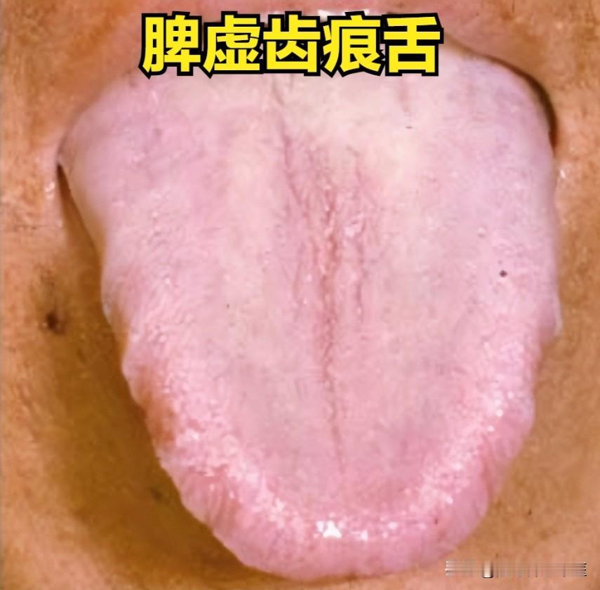 脾虚会齿痕舌，阳虚会齿痕舌，肝郁也会齿痕舌，教你一招，消除齿痕舌

1、脾虚——