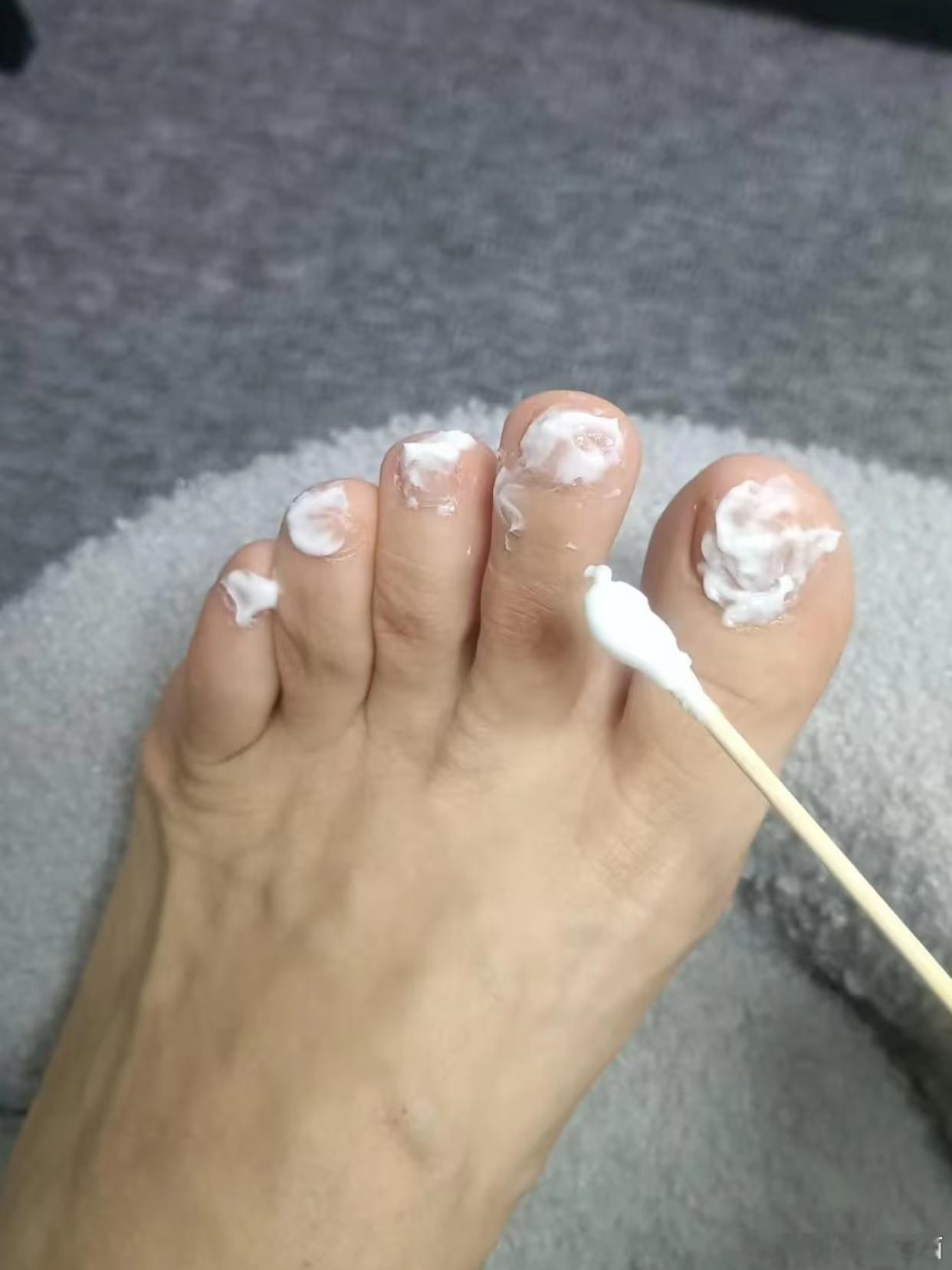 👨🍼 灰指甲一周年快乐