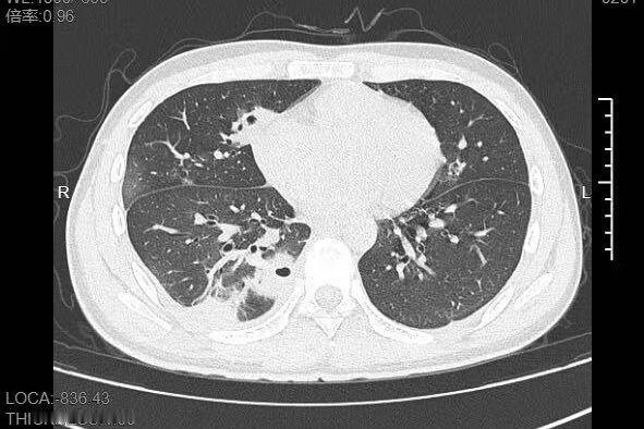 最近“20岁男生脸上挤痘痘挤进ICU”的话题冲上热搜。20岁大二学生小林，为准备