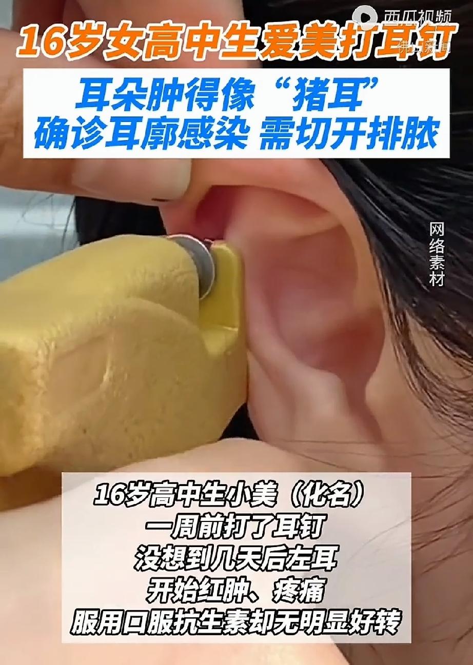看着都疼，16岁女孩打耳洞7天后却肿成了“猪耳朵”！耳廓化脓性软骨膜炎。
想起来