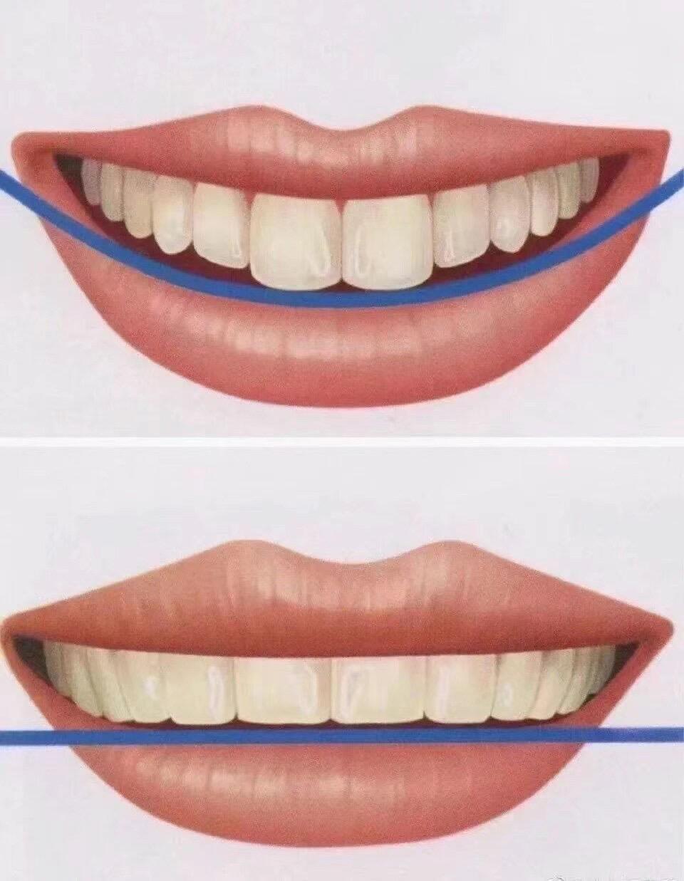 什么叫“微笑线”？微笑时，嘴唇轻轻打开👄露出元宝弧度的牙齿，彰显阳光甜美的气质