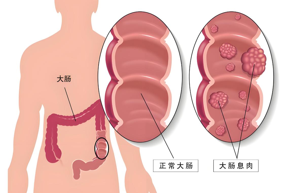 肠息肉，记住6个字，息肉越来越小
最近门诊上肠息肉的患者越来越多，很多还都是复发