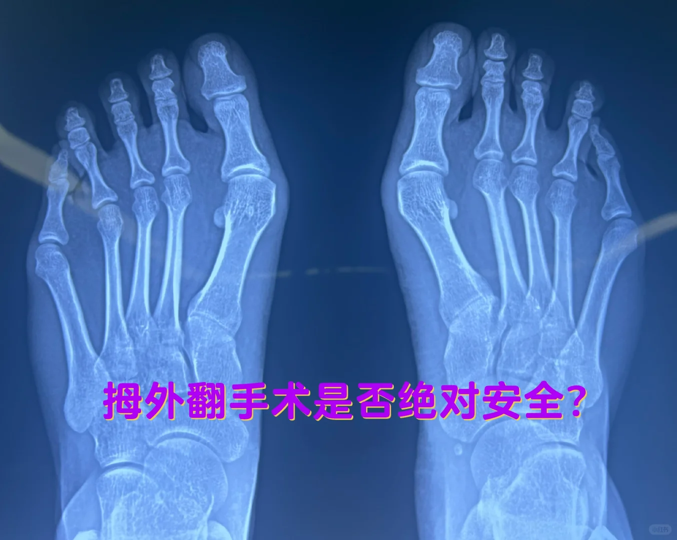 拇外翻手术是否绝对安全？