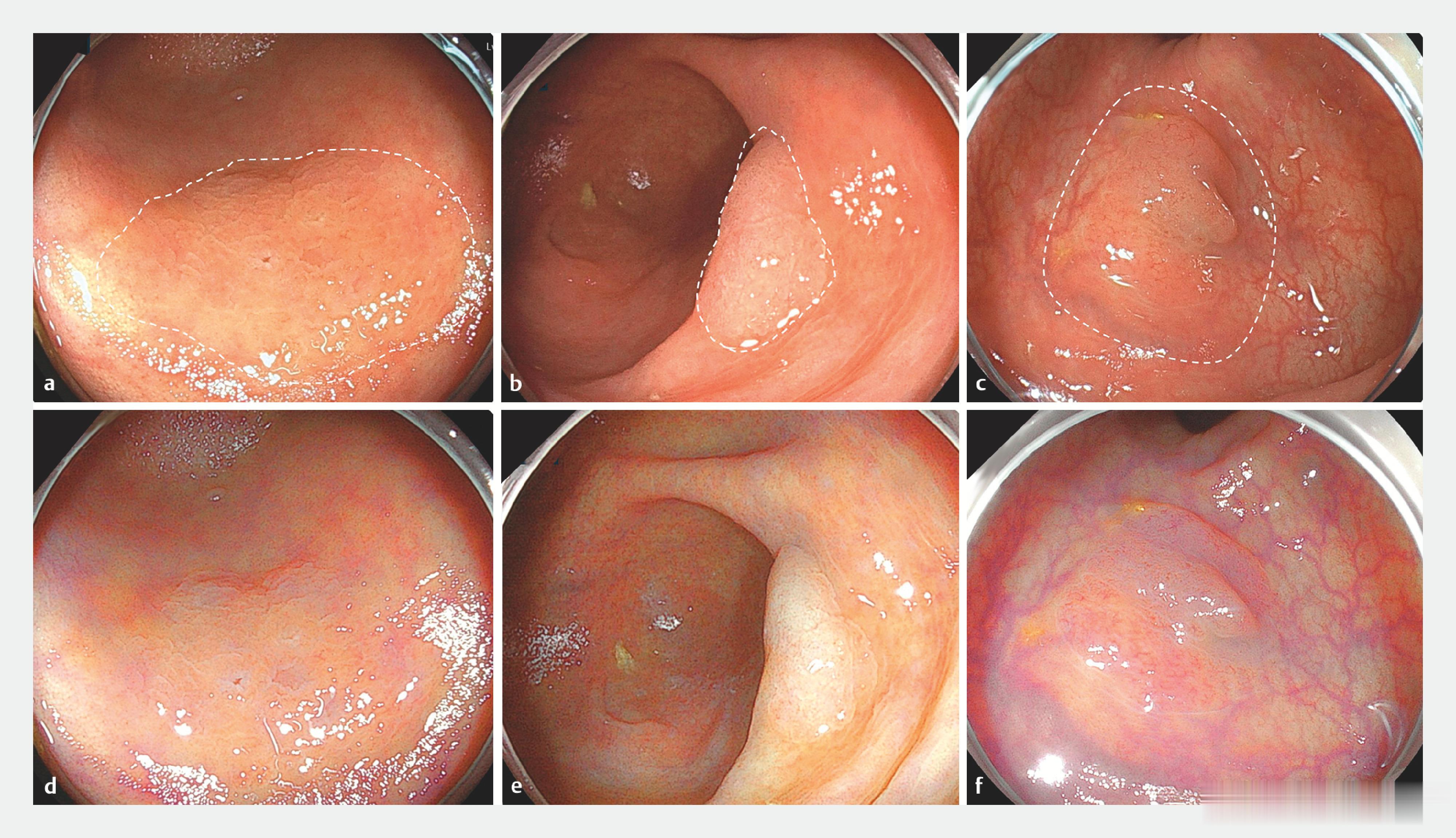 无蒂锯齿状病变（sessile serrated lesion， SSL）：SS